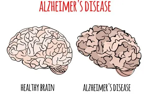 Alzheimer's Disease