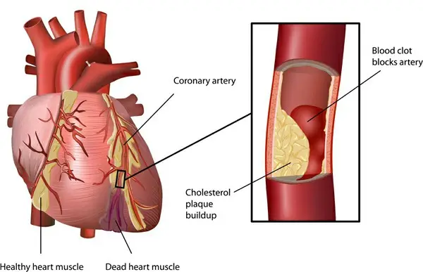 atherosclerosis