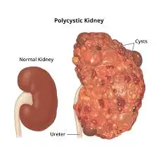 Kidney Disease